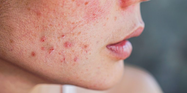 Lee más sobre el artículo Acné, cómo afecta a la piel y cómo podemos ayudarte